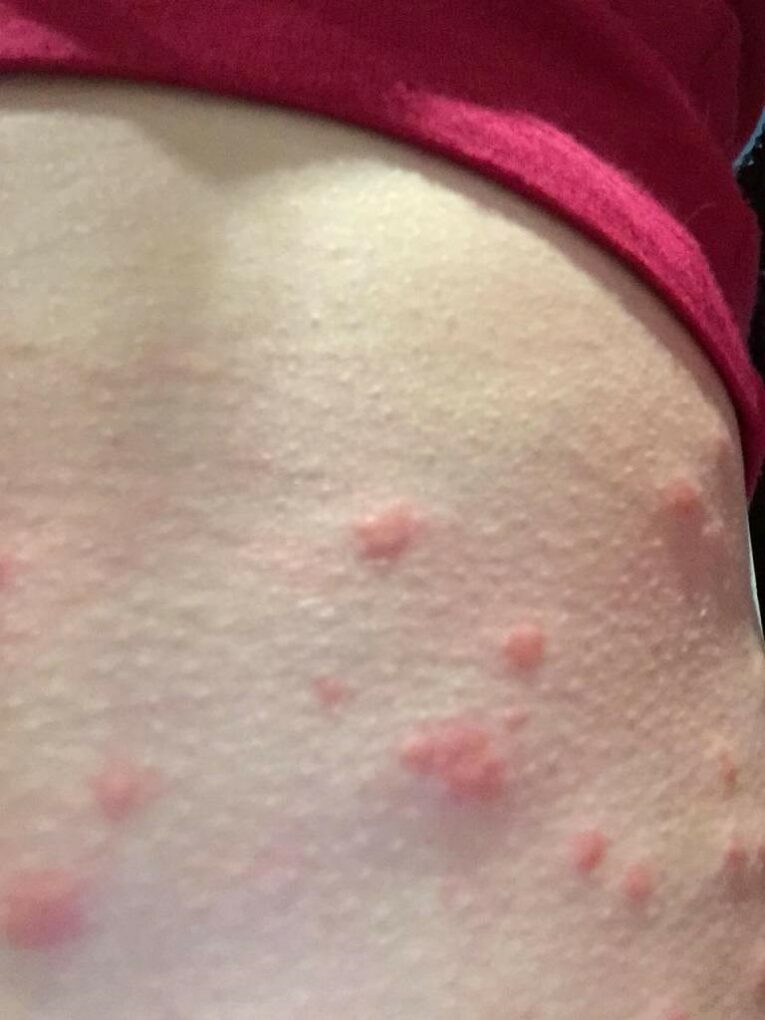 Midges! And I Thought Mozzies Were Bad! Wild Women On Top